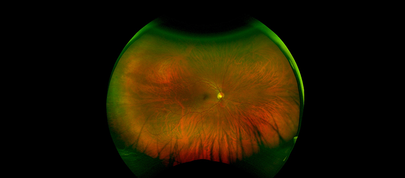 optomap retinal exam