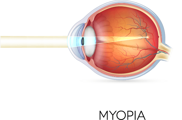 myopia vision